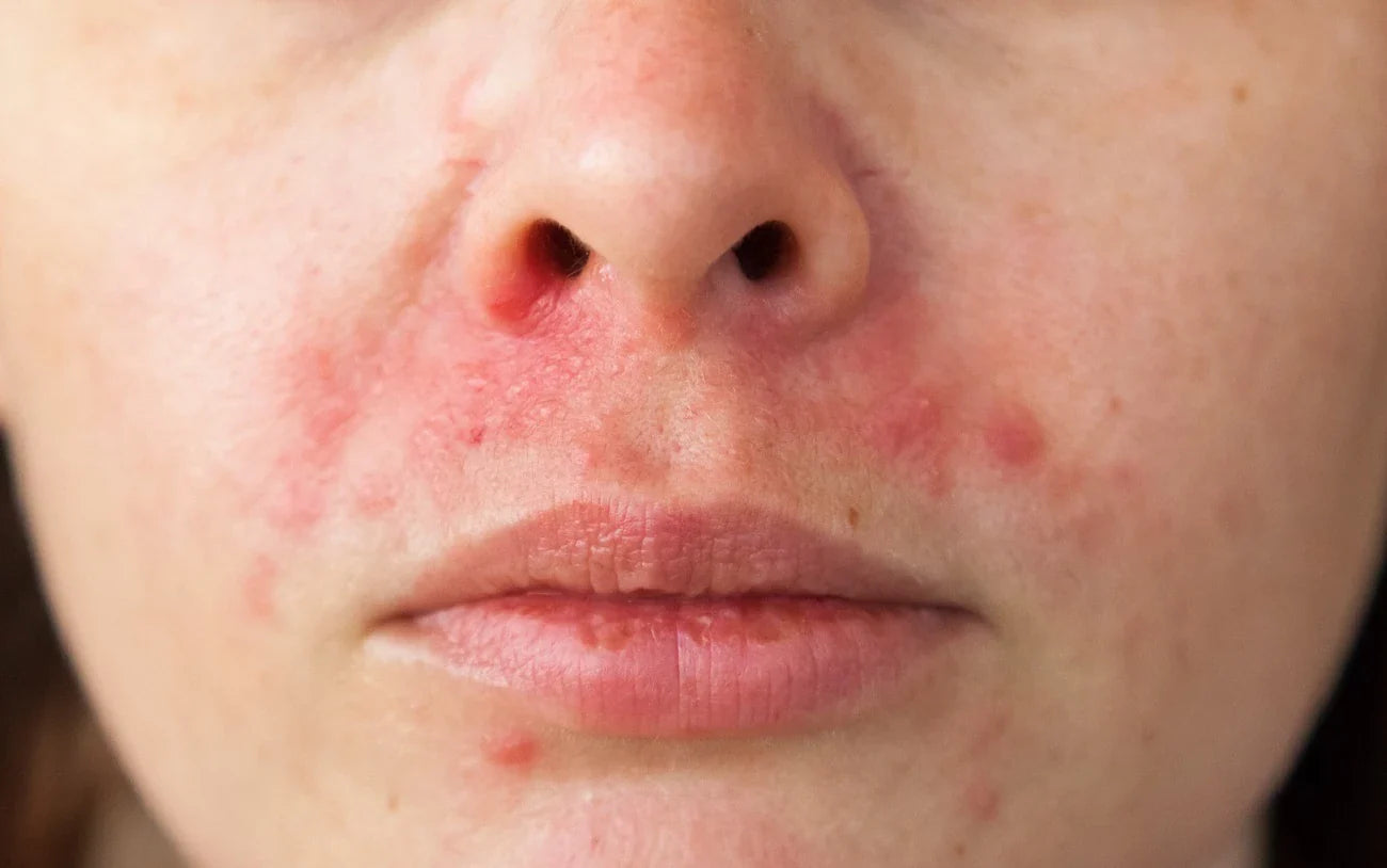 Candida on face deals