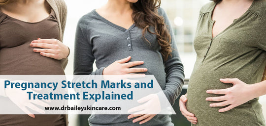 pregnancy stretch marks explained