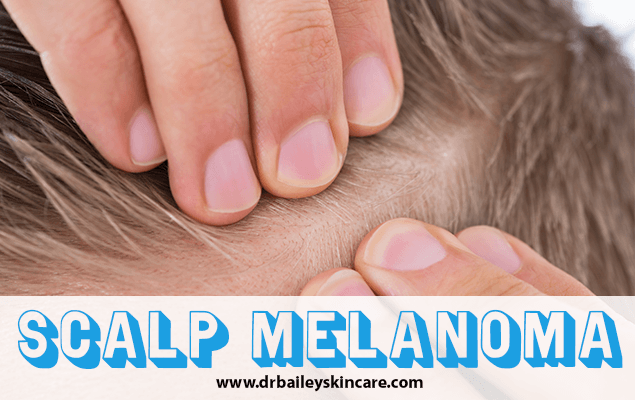 Scalp Melanoma