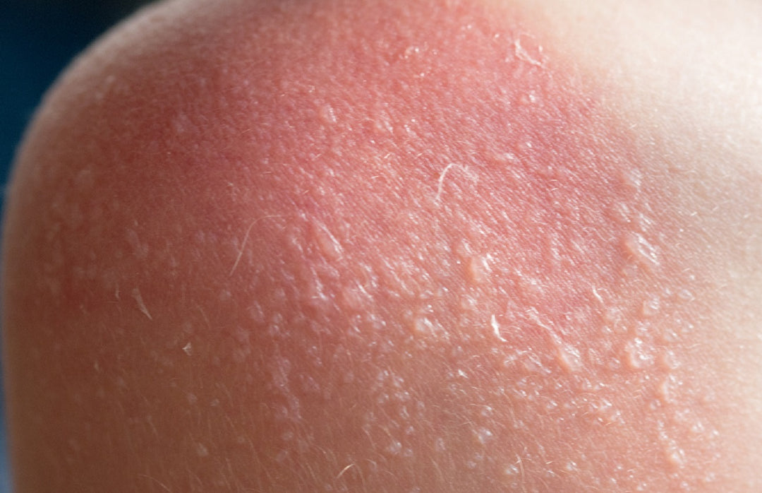how to treat a sunburn