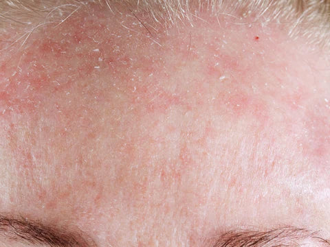 Best Treatment for Flaky Facial Skin from Dandruff and Rosacea