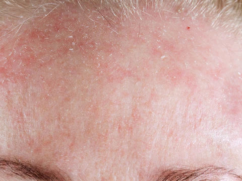 best treatment for flaky facial skin