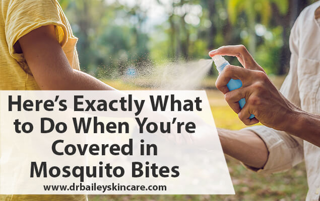 Here’s Exactly What to Do When You’re Covered in Mosquito Bites