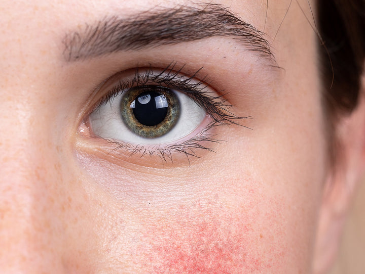 What Are The Skin Symptoms Of Acne Rosacea?