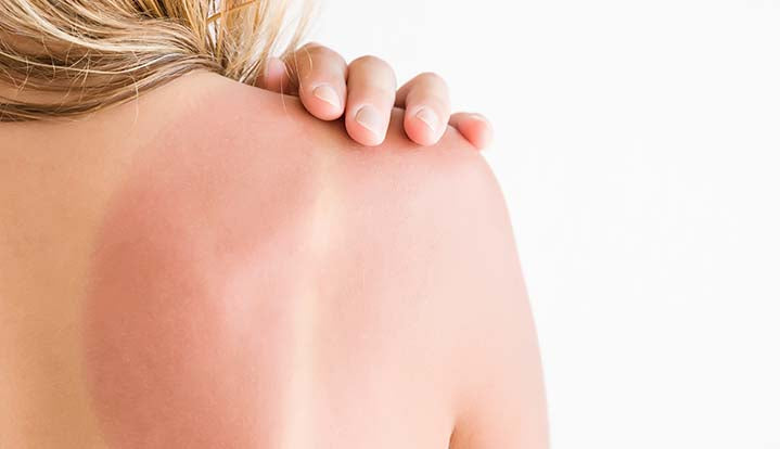 What is a sunburn?