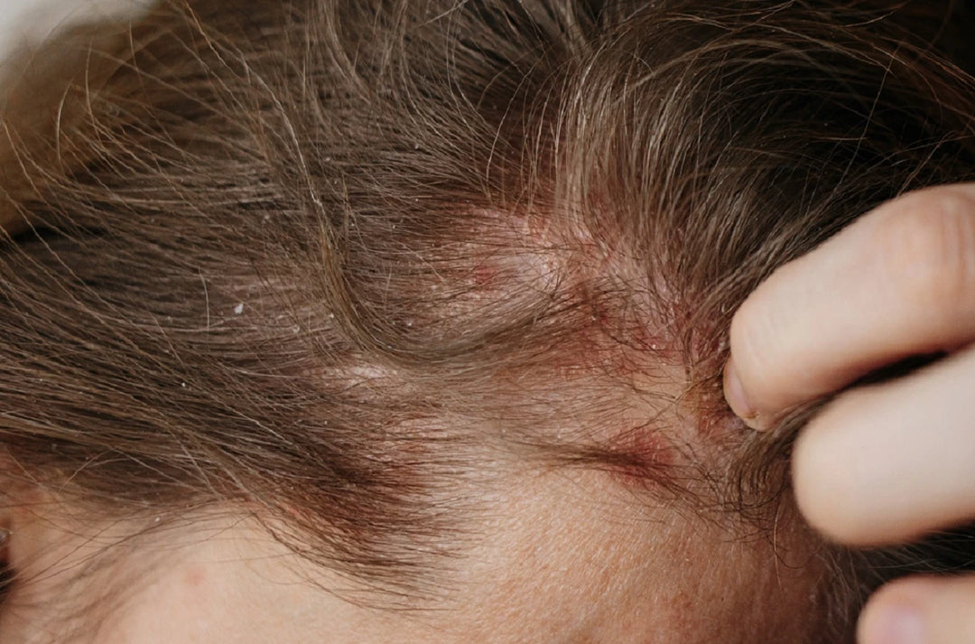 Treating Scalp Eczema