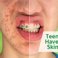 Teen Acne Clearing Kit