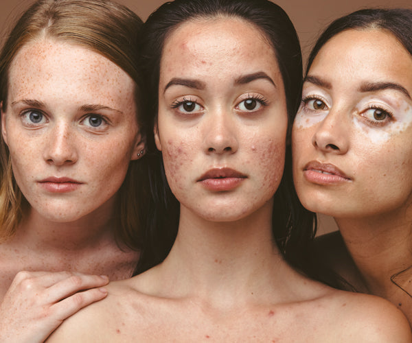 Fight Acne and Win!