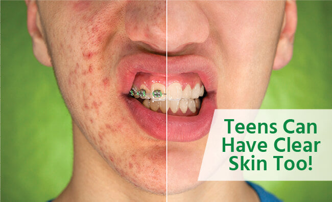 clear skin for teens