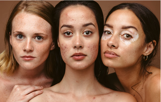 common reasons why your acne treatment is not working