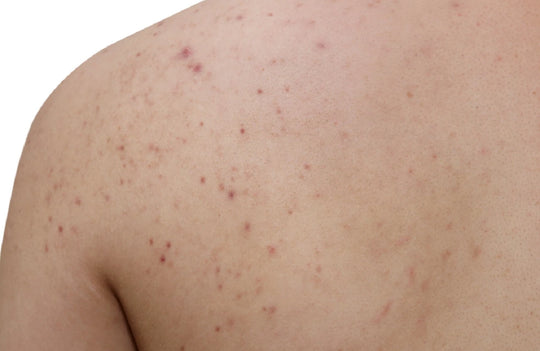 how to treat pityrosporum folliculitis acne