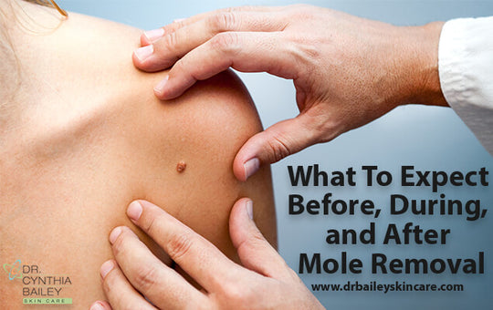 What To Expect Before, During, and After Mole Removal