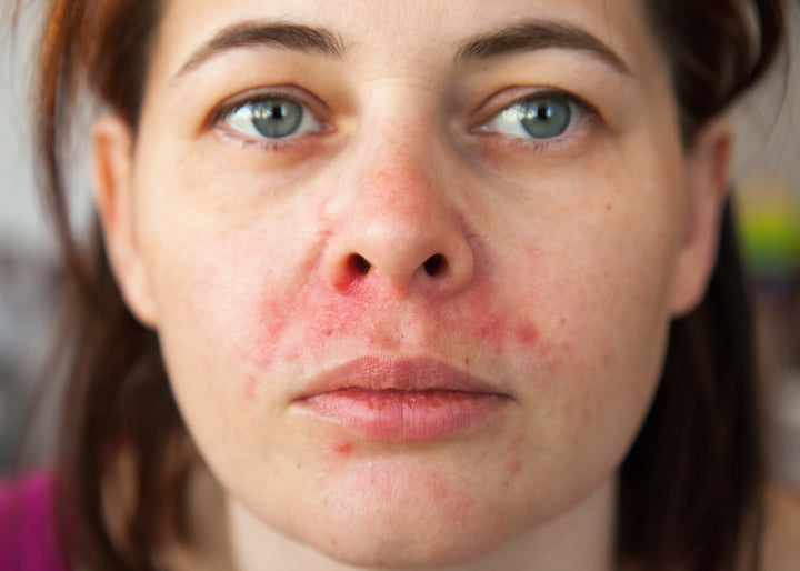 Perioral dermatitis is red facial rash around the mouth, nose, eyes and get be treated with the right approach.
