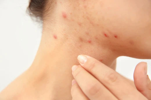 Pityrosporum folliculitis acne treatment
