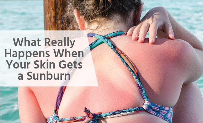 dermatologist explains what happens to your skin when you get sunburned