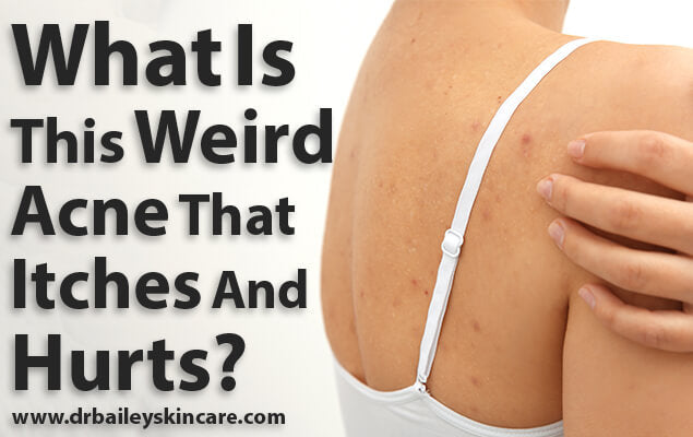 acne that itches and hurts Pityrosporum folliculitis fungal yeast acne