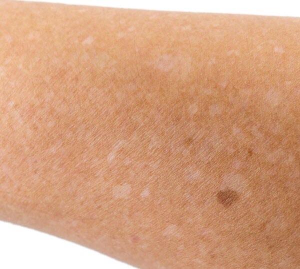 What are White Spots on Skin: Causes & Treatments