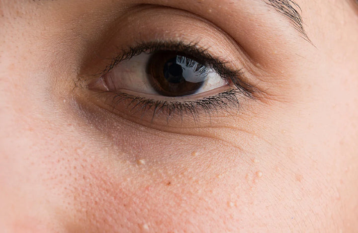 what causes bumps under the eyes that look like chicken skin