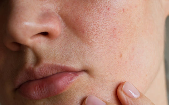 can you have rosacea or facial dandruff on just one side of your face