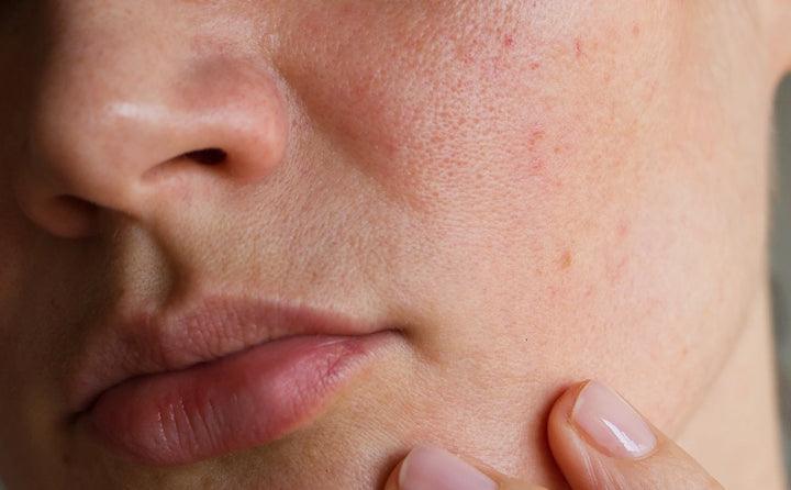 Can You Have Rosacea or Facial Dandruff on Just One Side of the Face?
