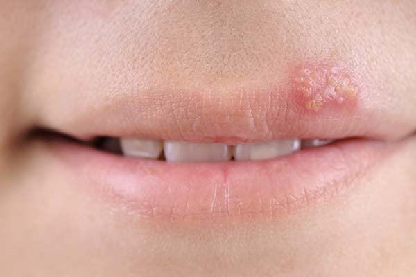 cold sores or fever blisters they are one and the same