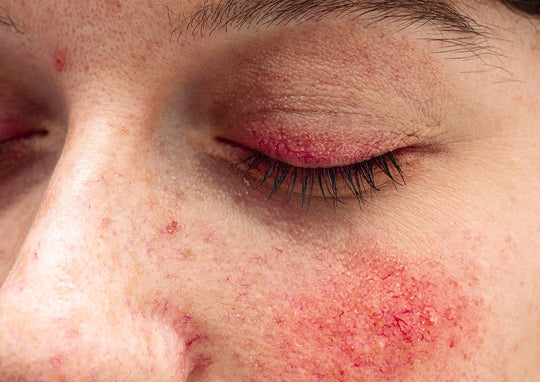 Demodex mites and rosacea on facial skin are linked and can be treated.