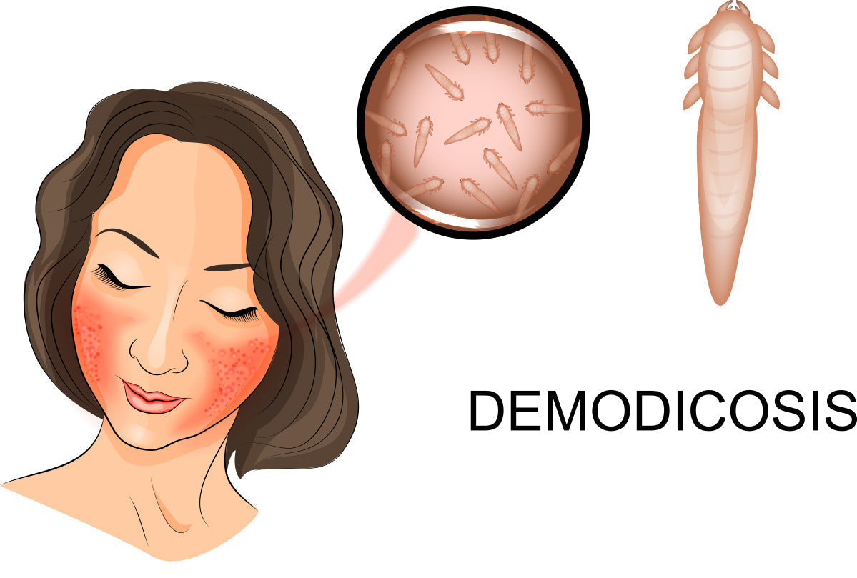 Demodex Mites and Rosacea: Treatment Methods and Causes