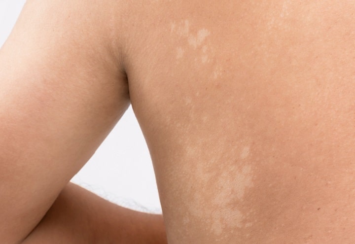 Fungus white patches, Tinea Versicolor, on the skin of someone's back.