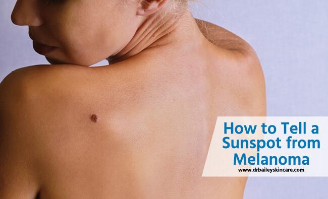 how to tell a sunspot from melanoma