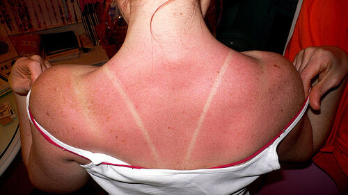 best natural sunburn treatment remedies and what happens to your skin when you get sunburned