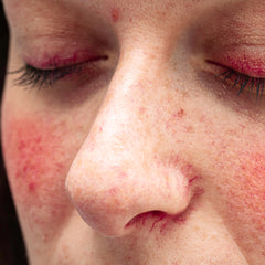 sensitive-skin